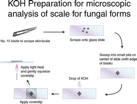 Skin Lesion KOH Exam: Purpose, Procedure, and Results.